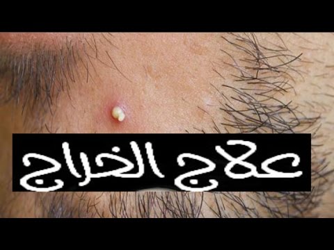 علاج الخراج , طرق علاج الخراج