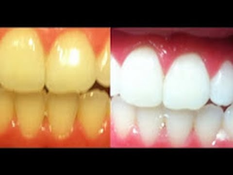 كيفية تبييض الاسنان - تعرفى على طرق تبييض الاسنان بسرعة الاسنان- بسرعة- تبييض- تعرفى- طرق- على- كيفية 3401 1