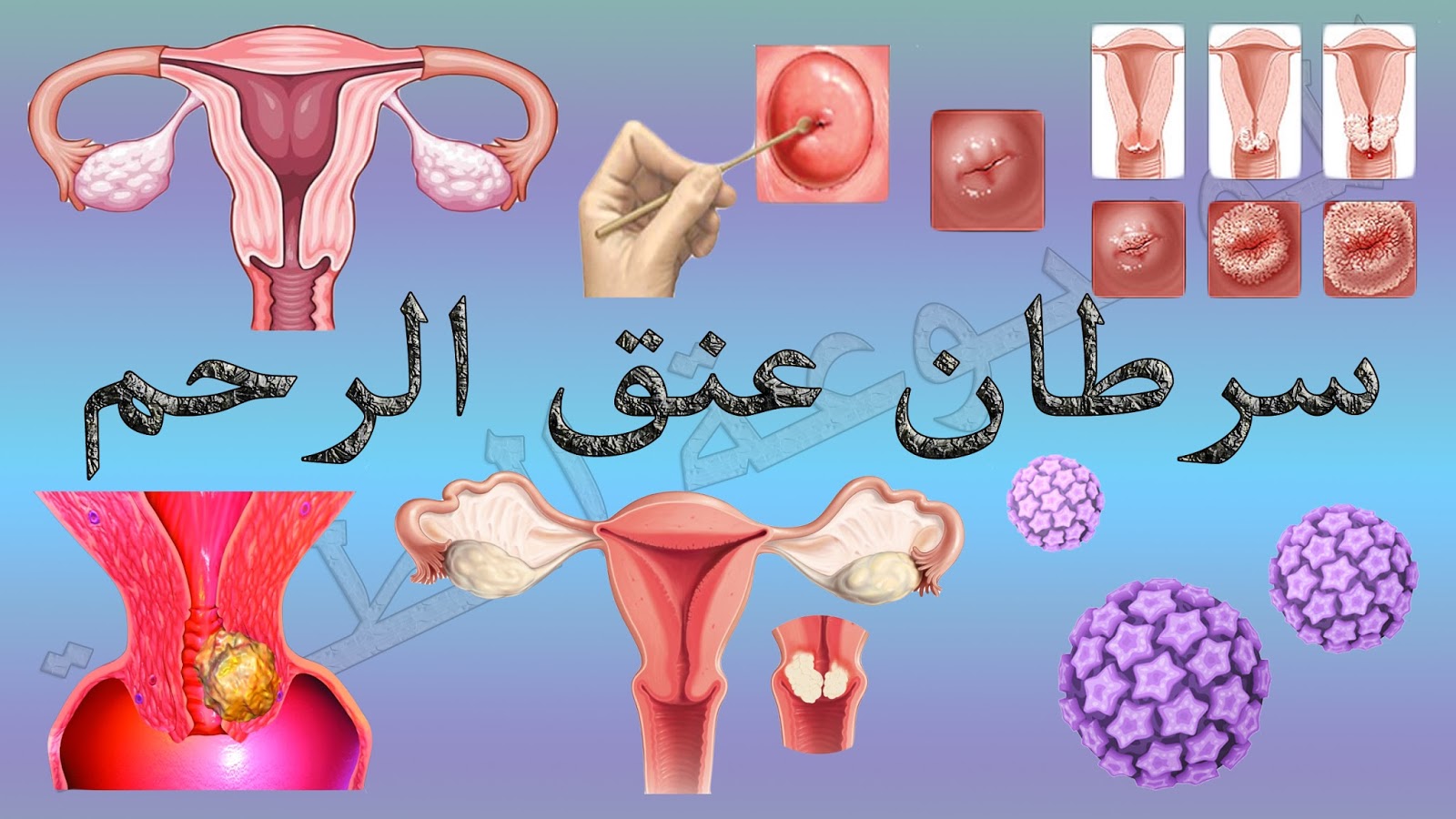 اعراض سرطان الرحم , اهم الاعراض التي تدل علي وجود سرطان في الرحم