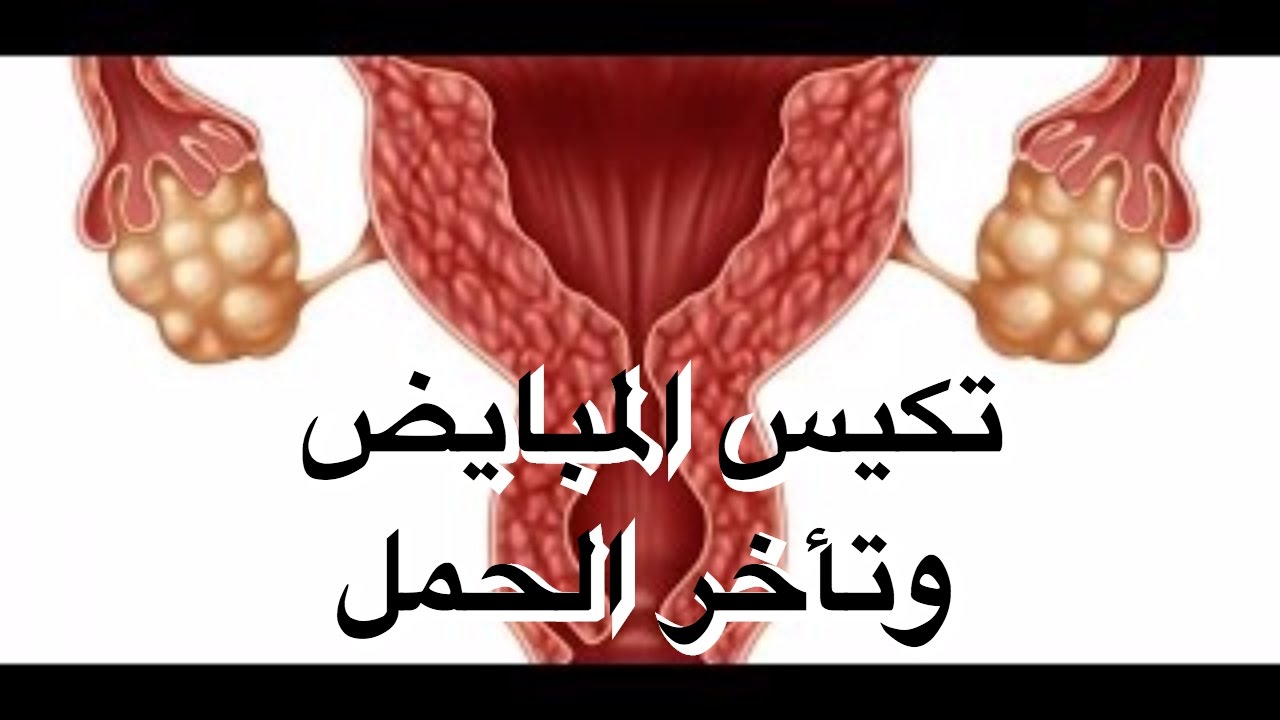 تكيس المبايض والحمل-تأثير تكيس المبايض على حدوث الحمل 15203