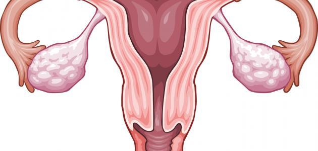 ماهي اعراض تكيس المبايض , اكتشف اعراض تكيس المبايض للفتيات