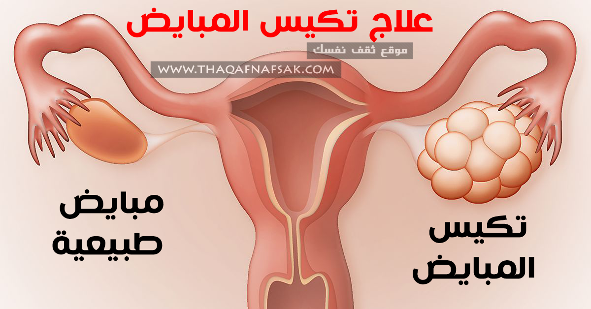 علاج التكيس 3663