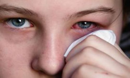 علاج حساسية العين - اسباب حساسية العين اسباب- العين- حساسية- علاج 4914 2