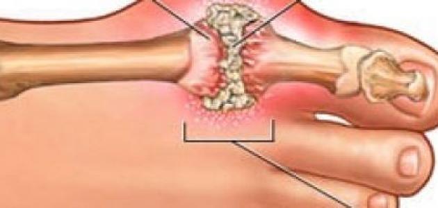 ما هو مرض النقرس - تعرف على مرض النقرس 5768