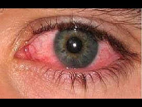 علاج حساسية العين , اسباب حساسية العين