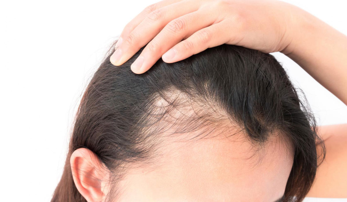 علاج تساقط الشعر للرجال - حل ظاهرة تساقط الشعر لدي الرجال الرجال- الشعر- تساقط- حل- ظاهرة- علاج- لدي- للرجال 3719 3