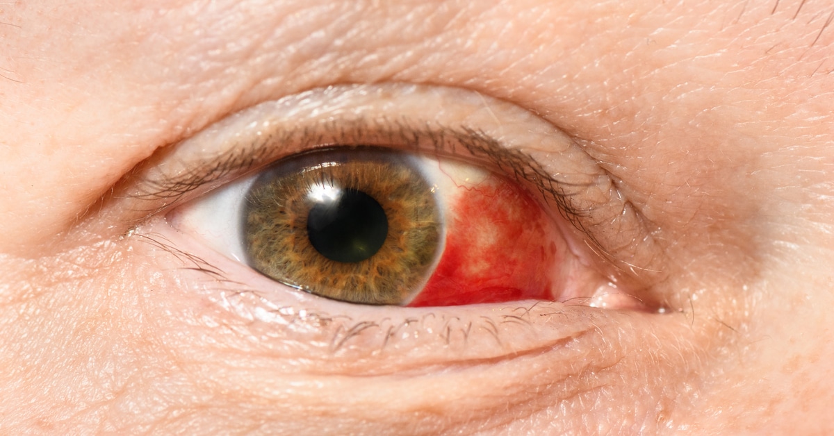 العين الحمراء الحمراء- العين 1807