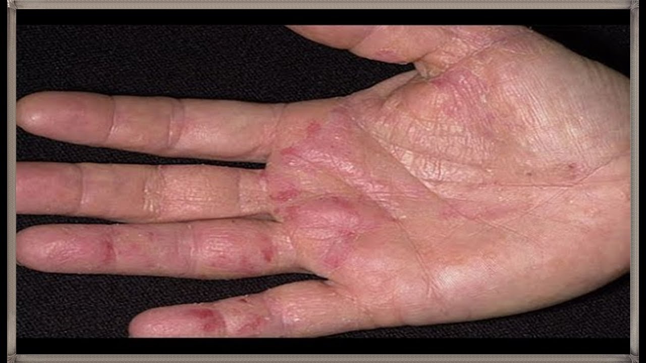 علاج اكزيما اليدين بالطب البديل , تعلم كيف تعلاج اكزيما اليدين بدون ان تاخذ الدواء