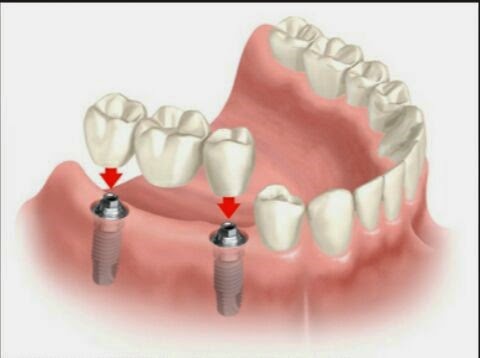 طقم اسنان - صورتركيبات صناعيه للاسنان اسنان- صناعيه- صورتركيبات- طقم- للاسنان 1245 3