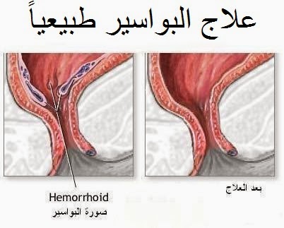 اسباب البواسير - اسباب مرض البواسير 4028 1