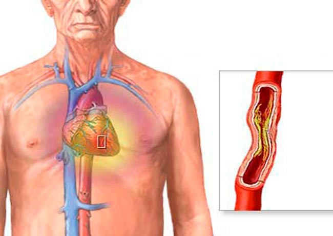 علامات انسداد الشرايين - ما هي علامات انسداد الشرايين 11671