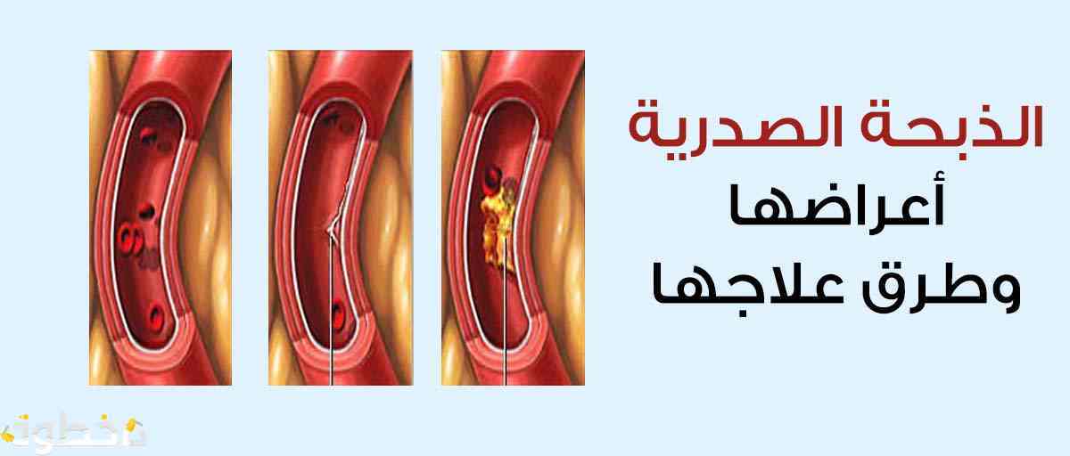 اعراض الذبحة الصدرية - اسباب الاصابة بمرض الذبحة الصدرية 4468 2