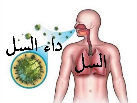 علاج مرض السل , اعراض وعلاج مرض السل