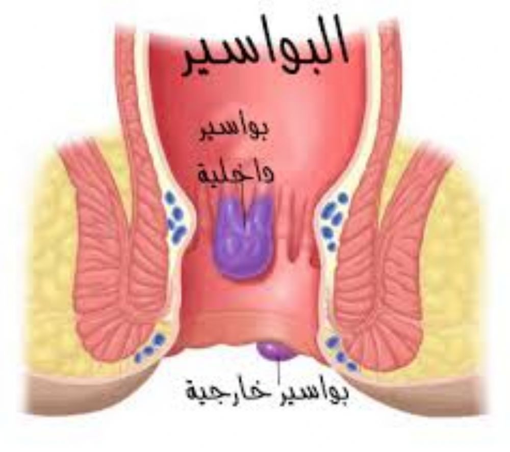 اسباب البواسير - اسباب مرض البواسير 4028